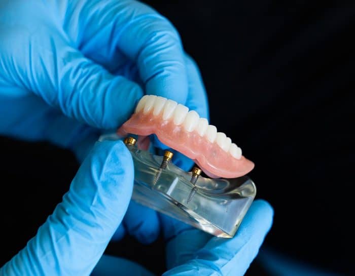 Comment faire tenir une prothèse amovible dentaire ?