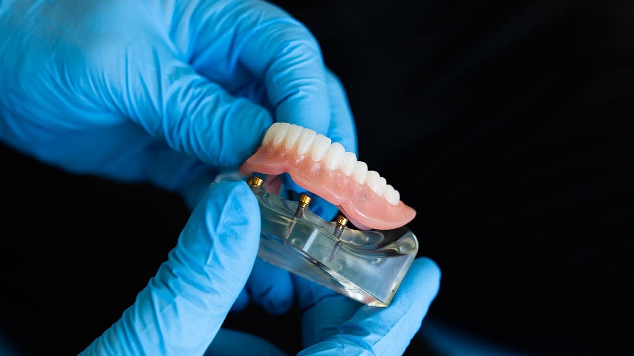 Comment faire tenir une prothèse amovible dentaire ?